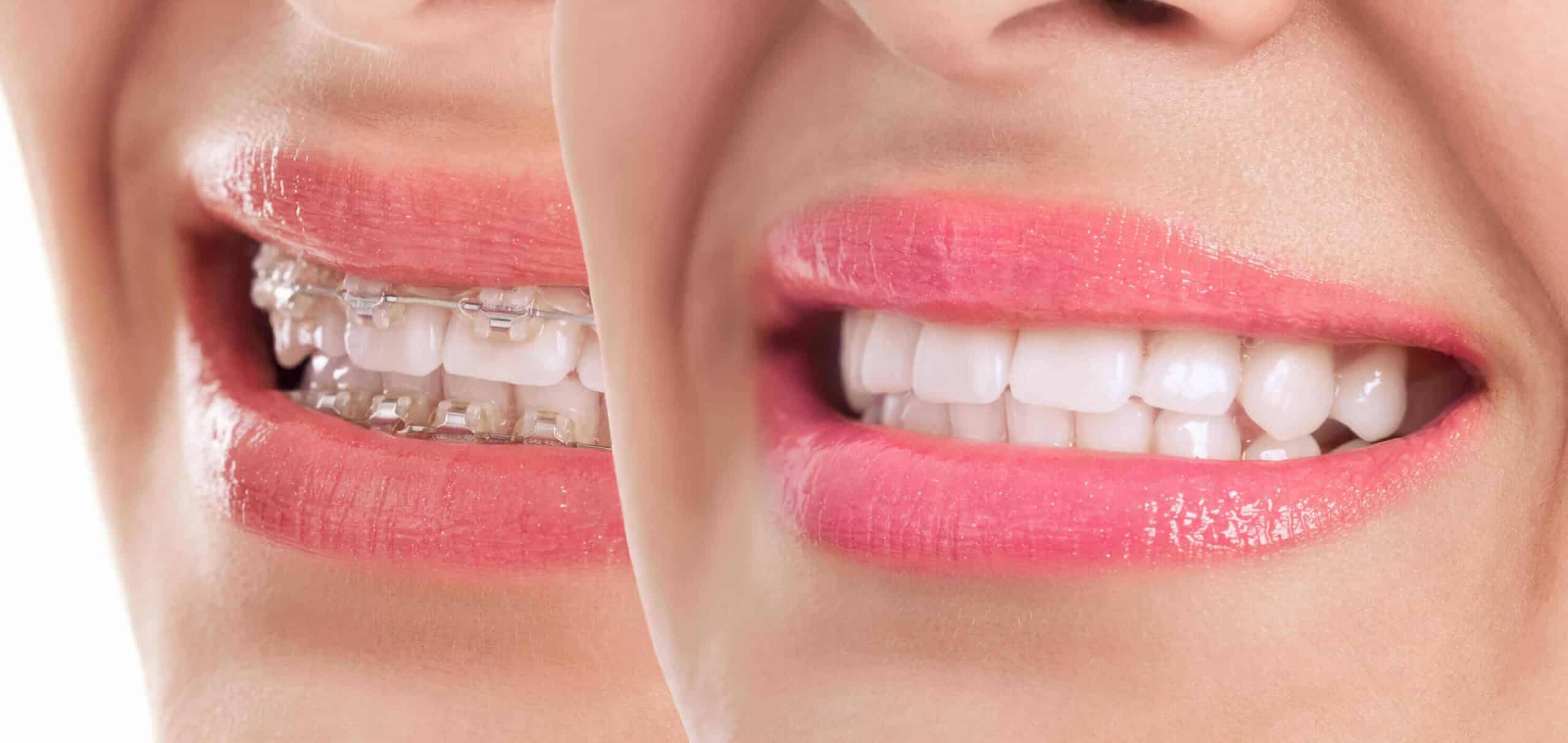 Featured image for “How To Avoid Braces”