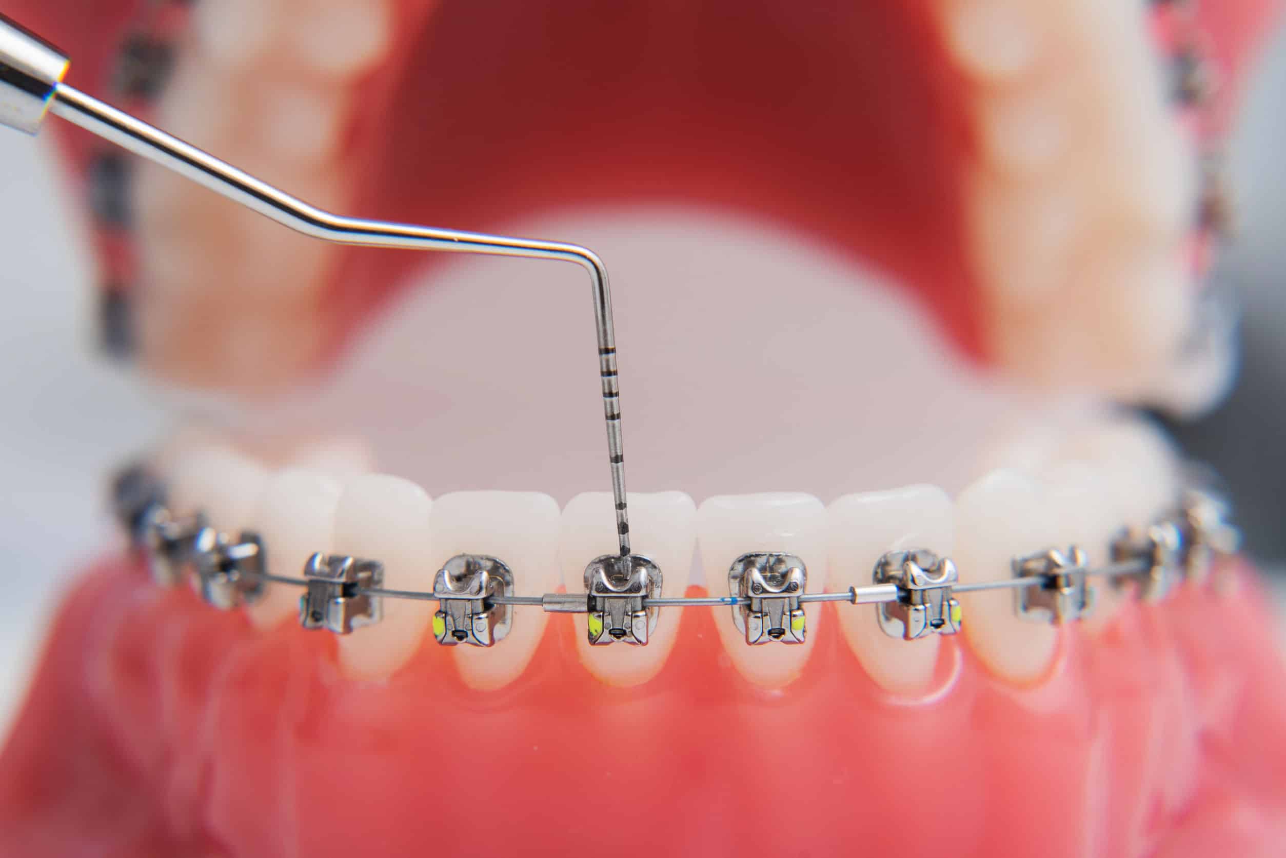 Featured image for “How Do Braces Move Teeth”