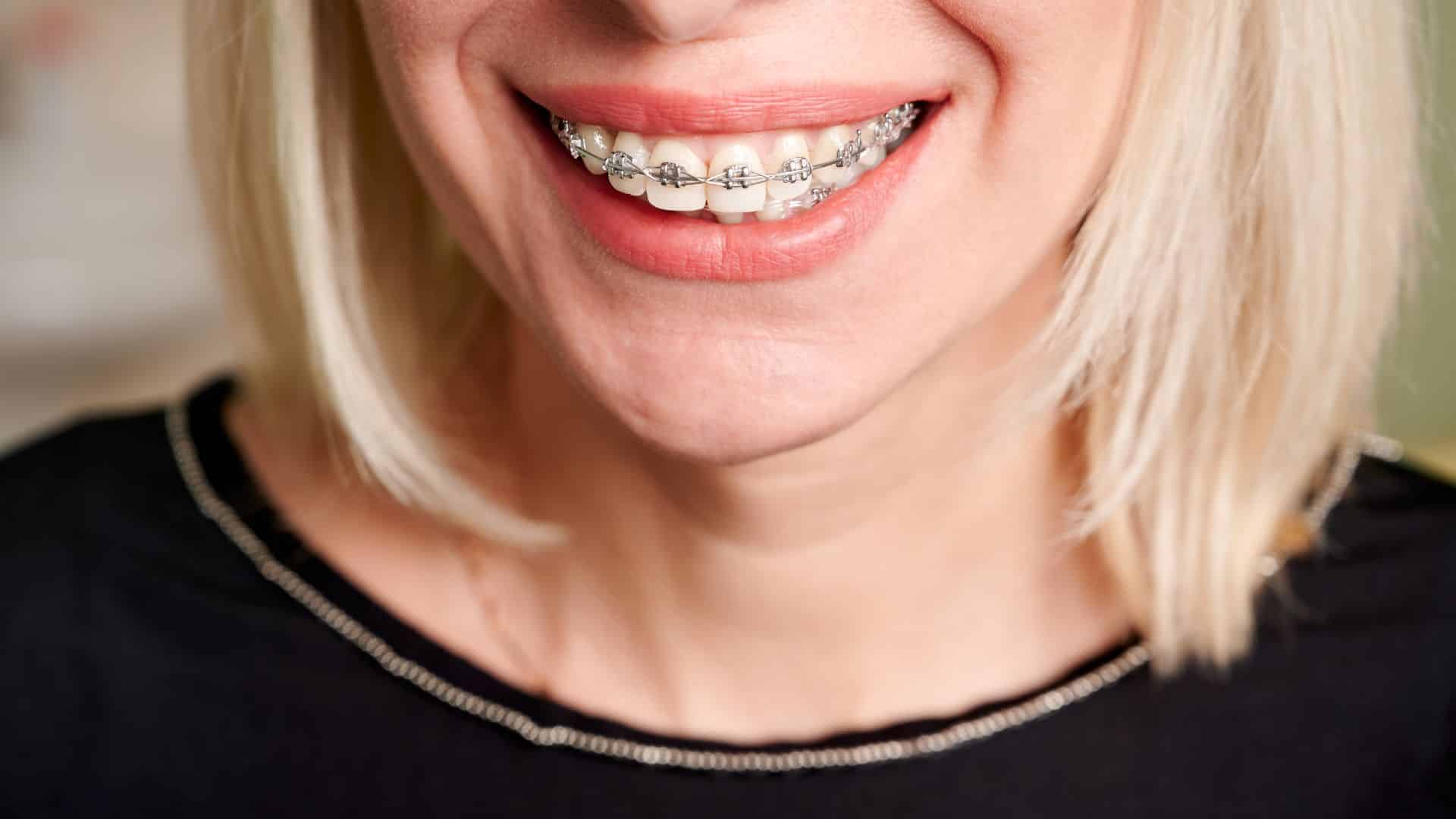Featured image for “Facts About Adult Braces”
